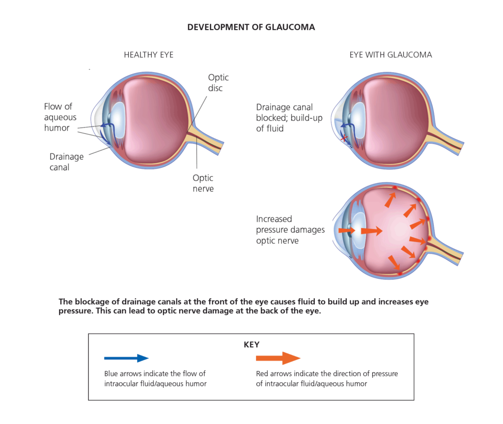Development Of Glaucoma