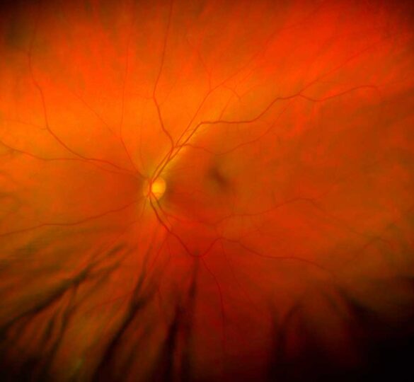 Promising New Procedure Targets Vascular Changes To Diagnose Glaucoma Early