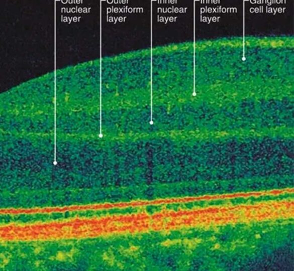 Unique Mapping Device Upgrades Glaucoma Eye Exam To Enhance Individualized Treatment