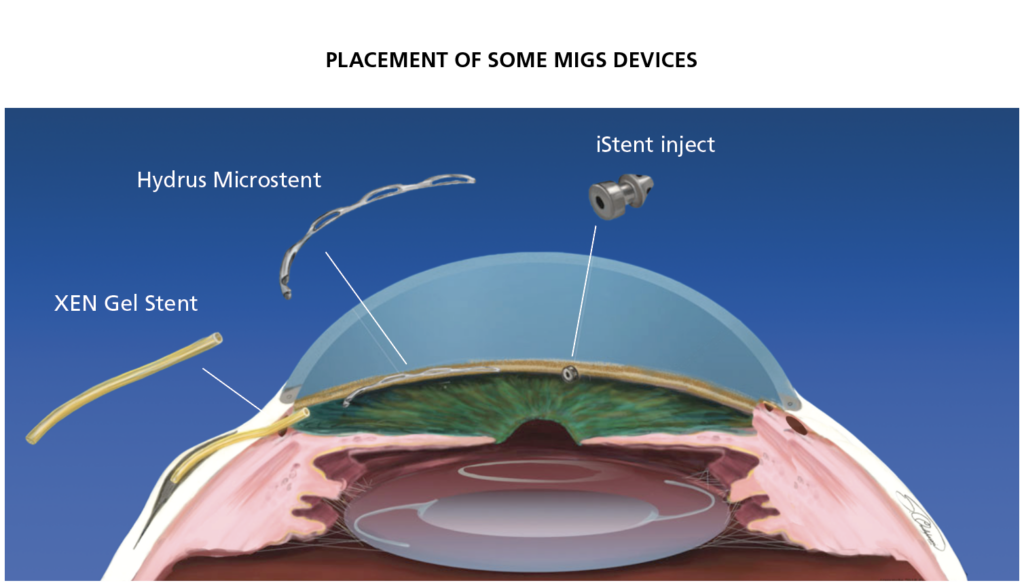 Placement Of Migs Devices