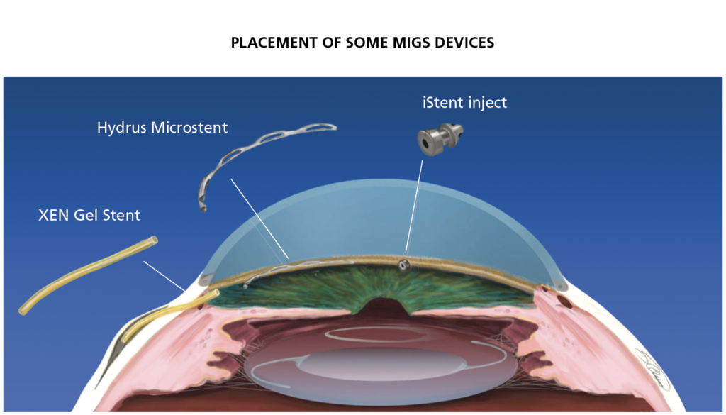 Migs Treatment Glaucoma Research Foundation 