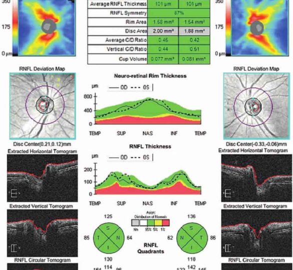 Optic Nerve Imaging