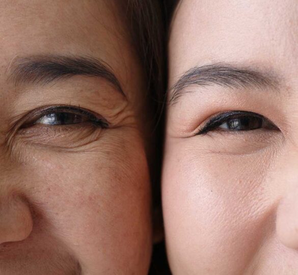 Glaucoma In Asian Populations