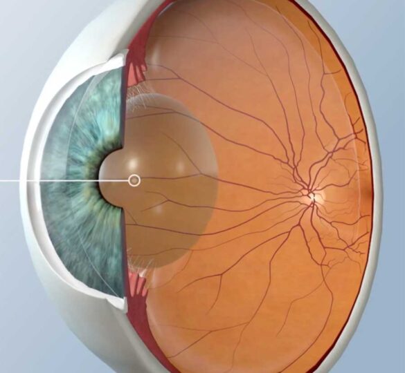 Cataract Surgery And Glaucoma
