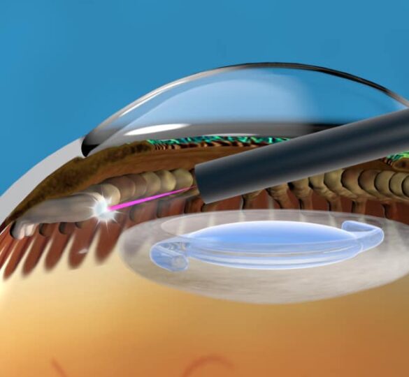 Endoscopic Laser Treatment