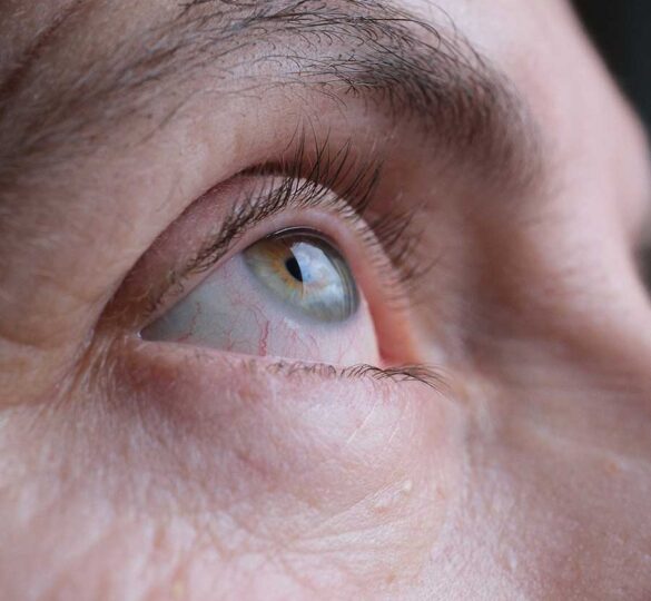 ¿Puede la presión ocular bajar demasiado? 1 Can I Have Laser Vision Correction?