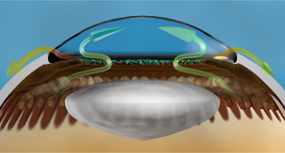 Illustration showing the glands in the eye (ciliary processes) that produce fluid