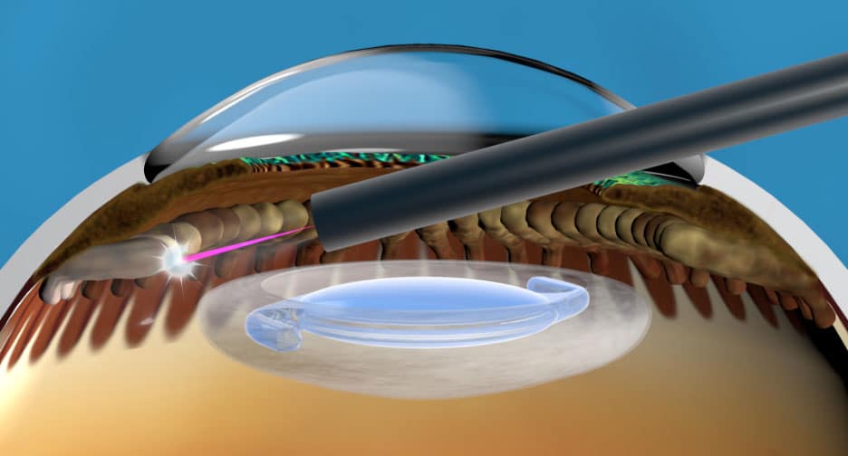Illustration showing the application of laser during Endoscopic Cyclophotocoagulation