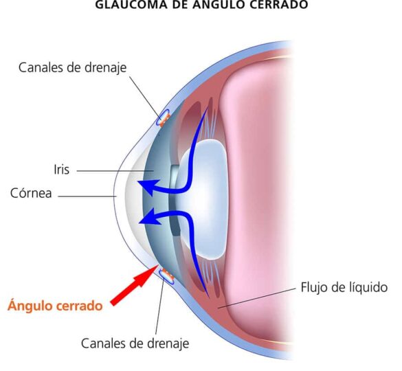 ¿Qué Es Un Glaucoma De Ángulo Cerrado?