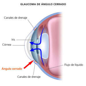 medical illustration of fluid pathway in angle-closure glaucoma with Spanish captions