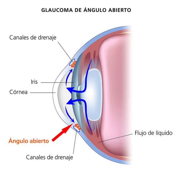 medical illustration of fluid pathway in open-angle-glaucoma with Spanish captions
