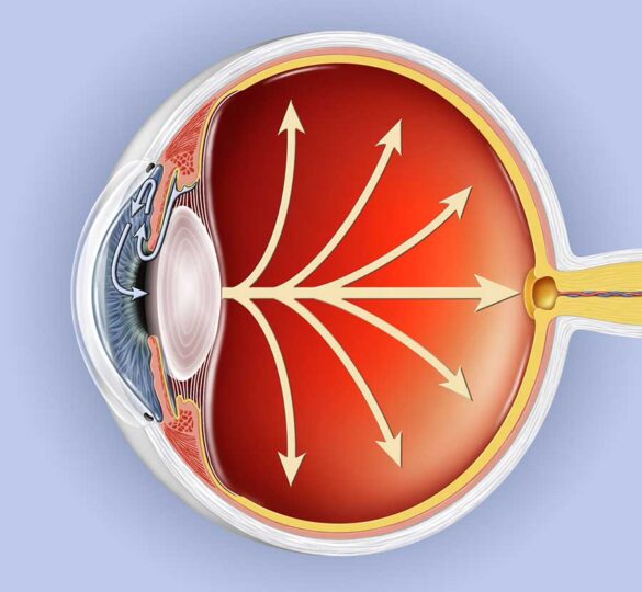 ¿Qué Es El Glaucoma Primario De Ángulo Abierto?