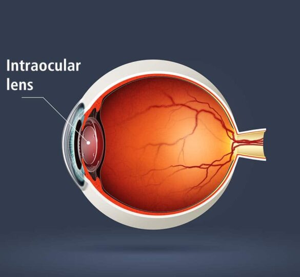 Premium Intraocular Lenses (Iols) For Patients With Glaucoma