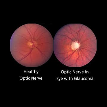 optic nerve comparison