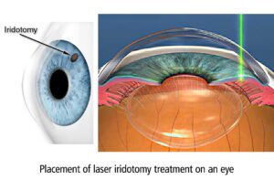 Placement of laser iridotomy treatment on an eye