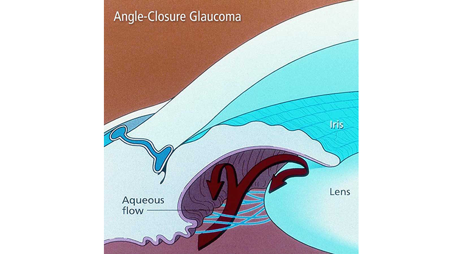 Angle-Closure Glaucoma: Symptoms & Treatment