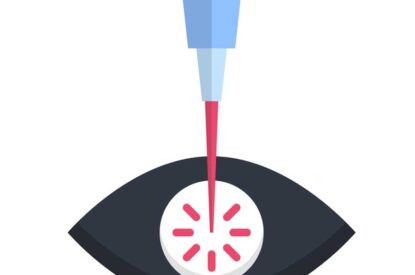 Update On Slt Laser Treatment