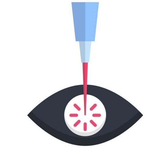 Update On Slt Laser Treatment