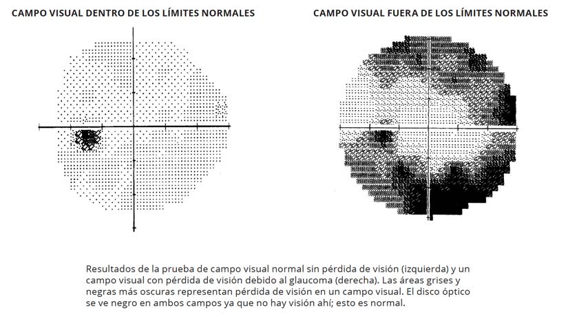 Deteccion De Glaucoma 3 Visual Field Test